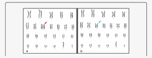 Karyotype 47,xy, 8 , B - Karyotype