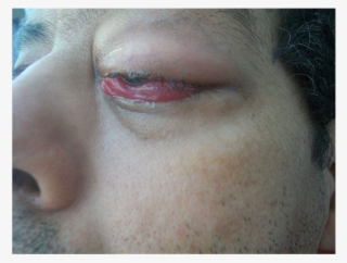 Orbital Abscess Secondary To A Left Frontal Sinusitis