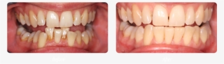 Fast Braces 4 Months