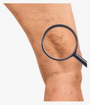 Protruding, Ropey Or Bulging Veins - Varicose Veins