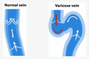 Get Rid Of Varicose Vein Symtoms By Dr - Vein