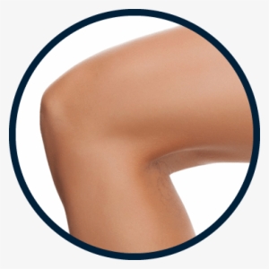 Ocean State Laser & Aesthetics, Spider Viens, Spider - Skin