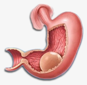 Gastric Balloon