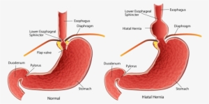 Our Stomach Is An Amazing Organ But It Has An Achilles - Hiatal Hernia