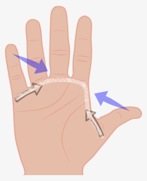 Is That Dupuytren Often Affects A Line Of Tissue Which - Glove