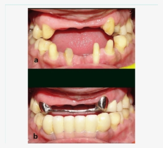 Pre Rehabilitation View And (b) Intraoral View Post