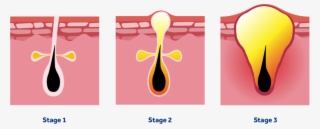 Different Grades Of Acne