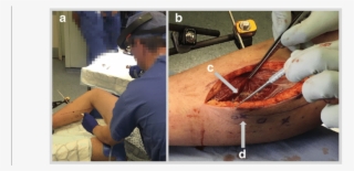 A Case 5 Marking Of Skin Under Hololens Guidance