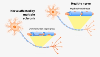 Multiple Sclerosis, Ms, Dubai