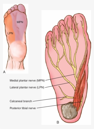 Compression Of Either The Posterior Tibial Nerve At