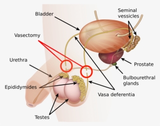Male Sterilization