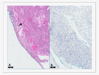 Biopsy Result Of Suspicious Gastric Mass Revealed Multiple