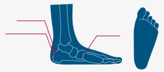 Types Of Flat Foot