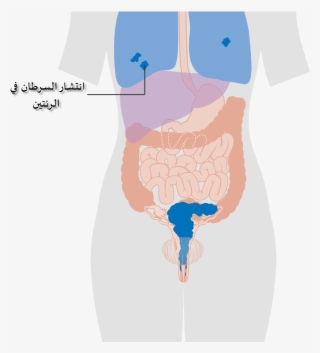 Diagram Showing Stage 4b Cervical Cancer Cruk 239-ar