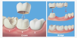 Crown-bridge