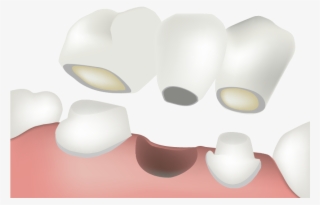 Porcelain Bridges