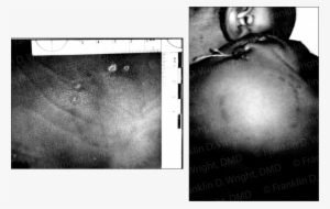 Human Bitemark Human Teeth Created The Pattern - Photograph