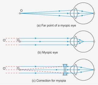Hypermetropia Or Far Sightedness - Curvature Of The Eye Lens