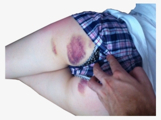 #transparent #ass #bdsm #nsfw #spanking #bruisespic