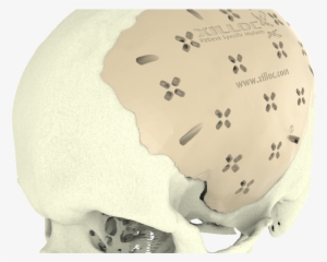 Cranial Implant - Implant