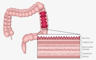 Anatomy Of The Colon - Tumour In Colon