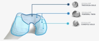 Episurf Medical Reaches Milestone Of 300 Implants - Diagram
