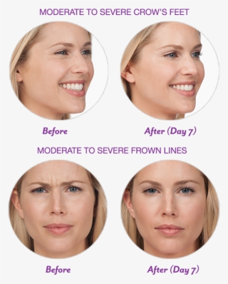 We Now Offer Botox Do You Have Crow's Feet Or Frown - Botox For Smile Lines