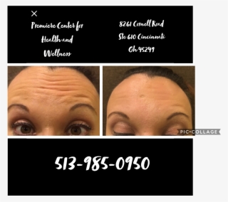 How Does Botox® Work