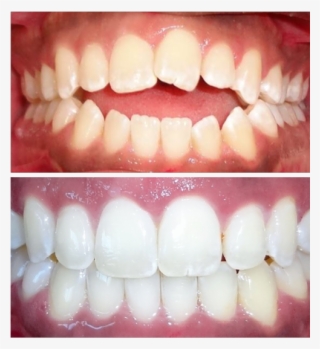 Invisalign Before And After - Dentures