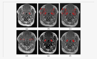 Results Of Fat Pads Segmentation Are Shown In Red Color - Computed Tomography