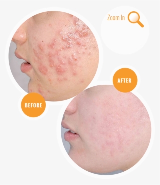 Acne Before And After Treatment - Acne Transparent