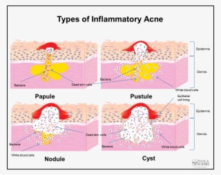 Cystic Acne Diagram Health Medicine And Anatomy Reference - Cystic Acne Diagram