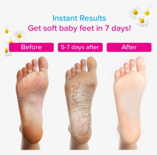 Daiwa Felicity Dream Feet Exfoliating Foot Peel Mask - Foot Peel Mask Before After
