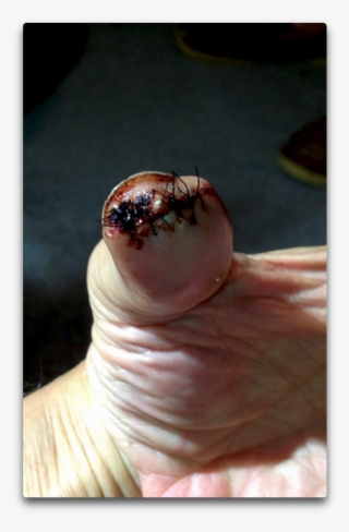 Bad Thumb - Insect