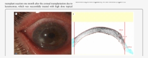 Fungal Keratitis In A Corneal Graft - Fungal Keratitis