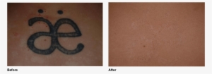 Tattoo Removal