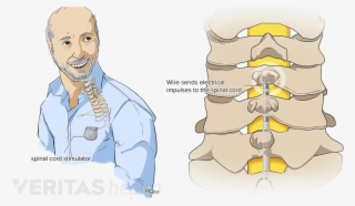 Spinal Cord Stimulators And Pain Pumps - Cartoon