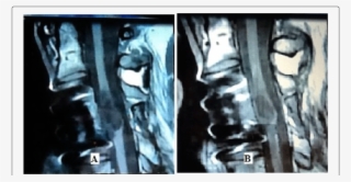 Tractographic Images Of Spinal Cord Of A Patient With - Visual Arts