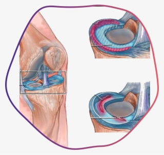 Ligament & Cartilage Tears - Illustration