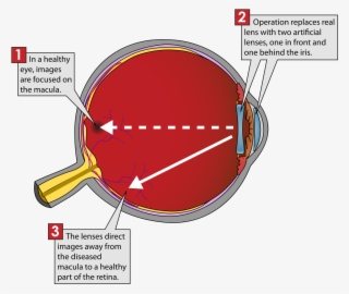 Iolvip - Implantable Miniature Telescope Diagram