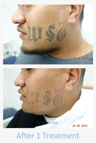 Facial Tattoo Removal - Poster