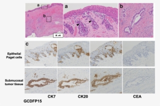 Paget Cells Were Scattered In Squamous Epithelium (a) - Art
