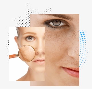 Manchas En La Piel - Veet Skin Discoloration