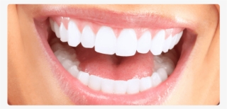 White Teeth - Does Straight Teeth Look Like