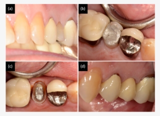 Patient Complained About The Second Premolar Tooth - Tongue