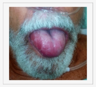 Rapidly Progressive Angioedema To The Tongue - Cat Yawns