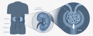 Fabry Disease Renal Symptoms Graphical Image - Illustration