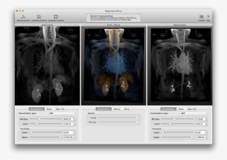 1003-10arterialvenousmip [795ko] - Computed Tomography