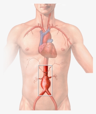 Abdominal Aortic Aneurysm