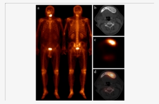 Patient 1 Presented With Newly Diagnosed Lung Cancer - Darkness